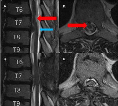 Case report: A vertebral bone spur as an etiology for spinal cord herniation: case presentation, surgical technique, and review of the literature